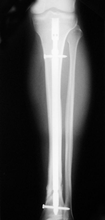 Tibia, Shaft:  Synthes Ti Nail (Implant 229)
